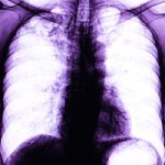 Israeli Immune-Response Algorithm Could Aid TB Diagnosis